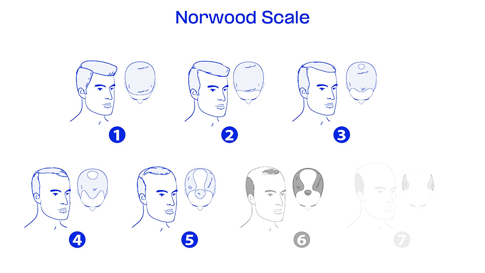 Norwood scale